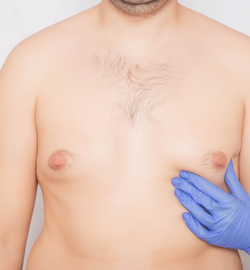 GYNAECOMASTIA