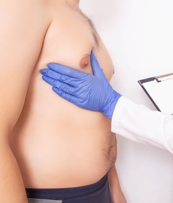 Gynecomastia