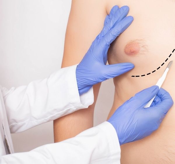 Gynecomastia