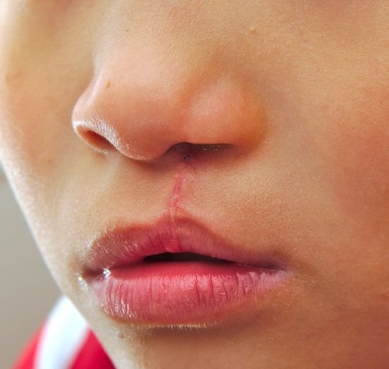 cleft-lip