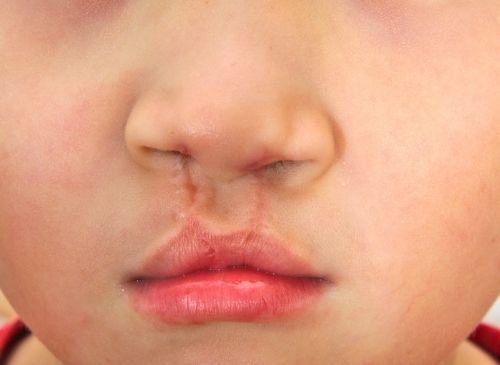 cleft-lip