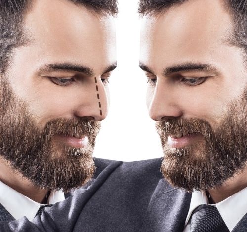 rhinoplasty